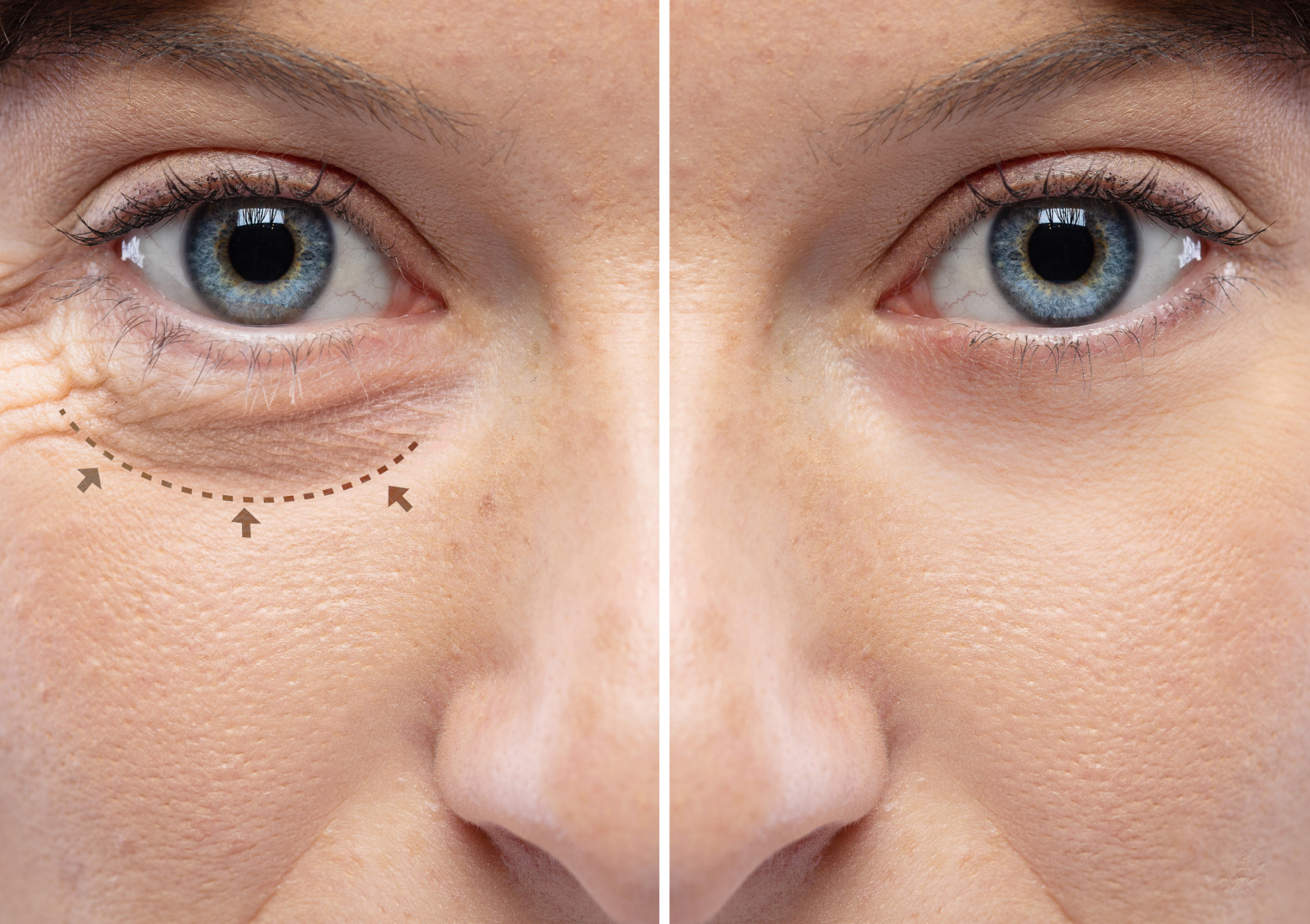 Cirurgia de Pálpebras